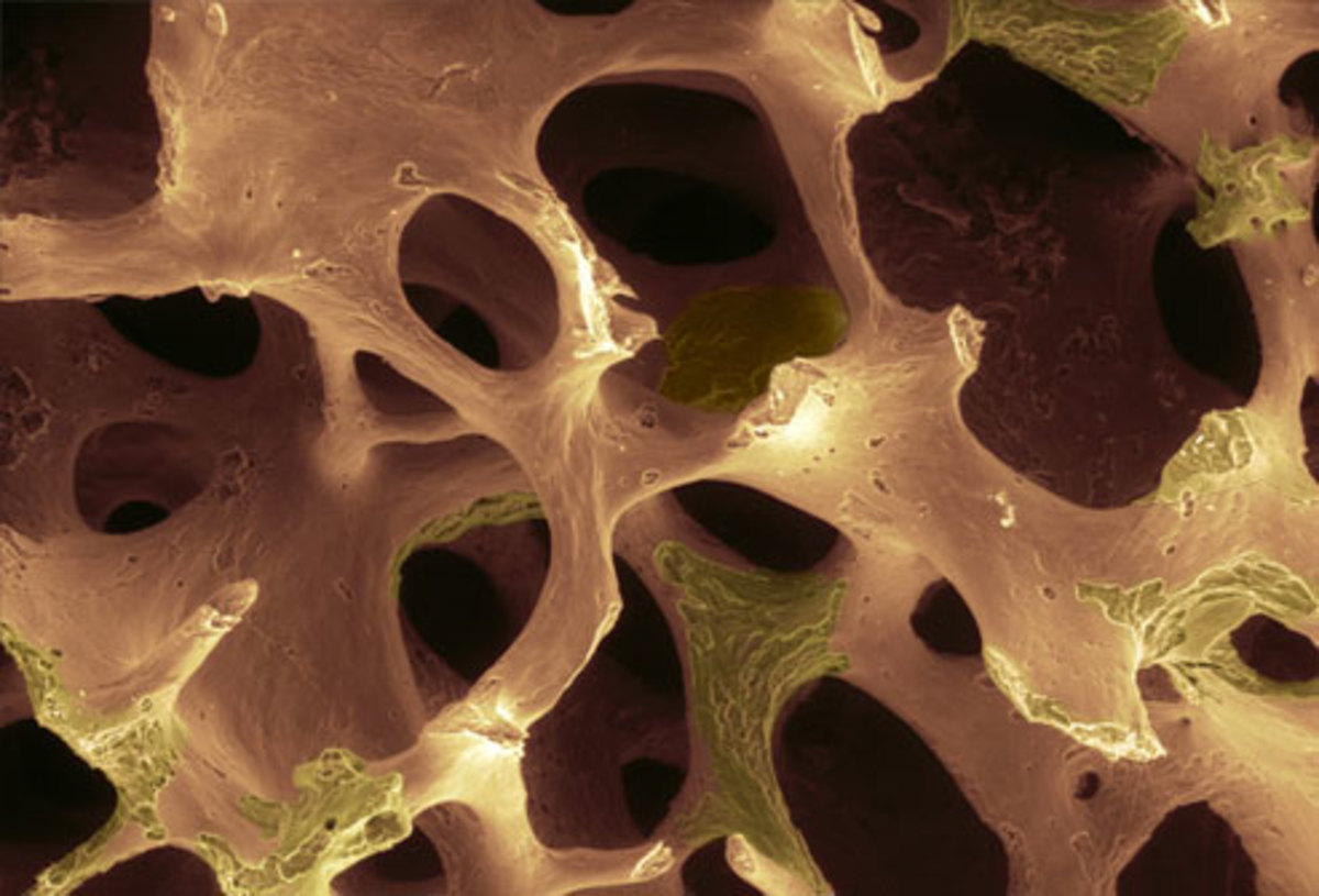 Новообразование костной ткани. Злокачественные опухоли костей презентация. Новообразования костей. Новообразование костной ткани. Новообразование костной ткани.