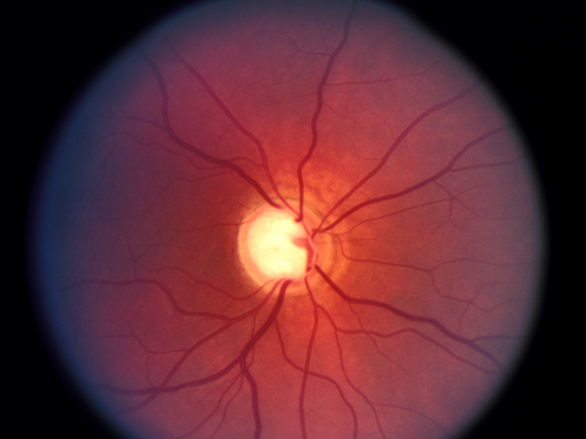 Состояние сетчатки. Передняя ишемическая нейрооптикопатия зрительного нерва. Ишемическая нейропатия сетчатки. Ангиопатия сетчатки глаза ou что это. Ишемическая нейропатия зрительного нерва.