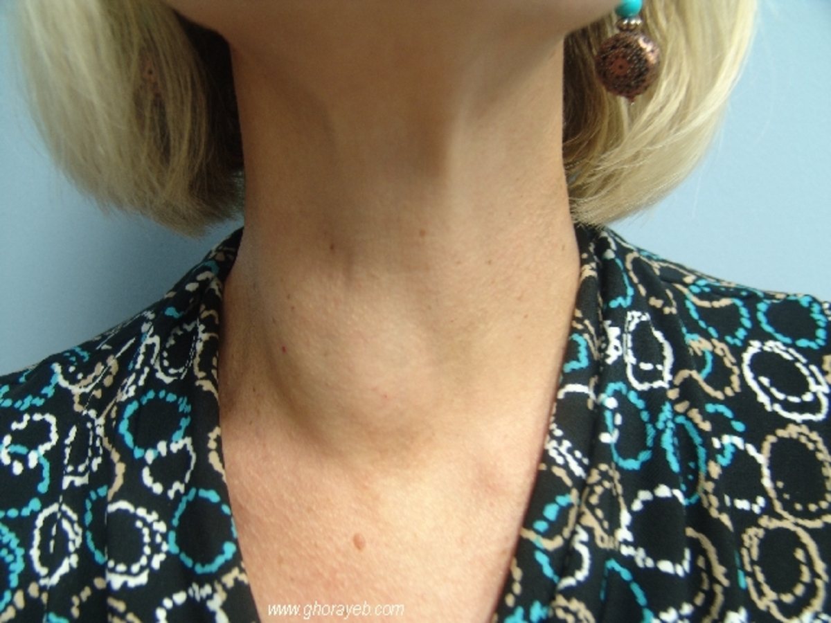 Увеличился узел щитовидной железы. Узлы в щитовидной железе.