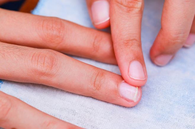 παρωνυχίδα