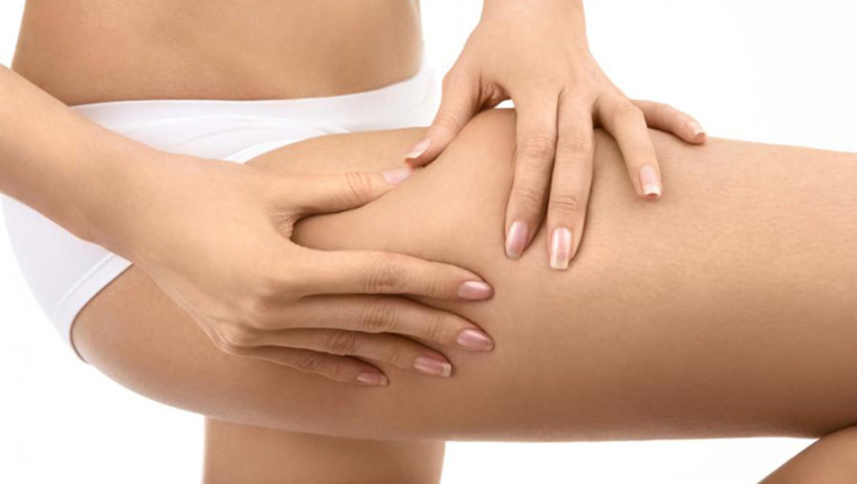 κρυολιπόλυση