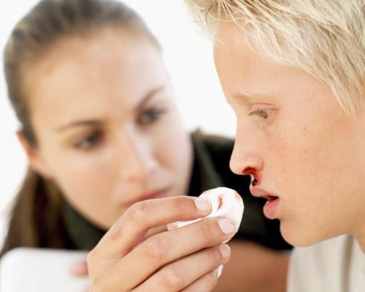 ρινορραγία