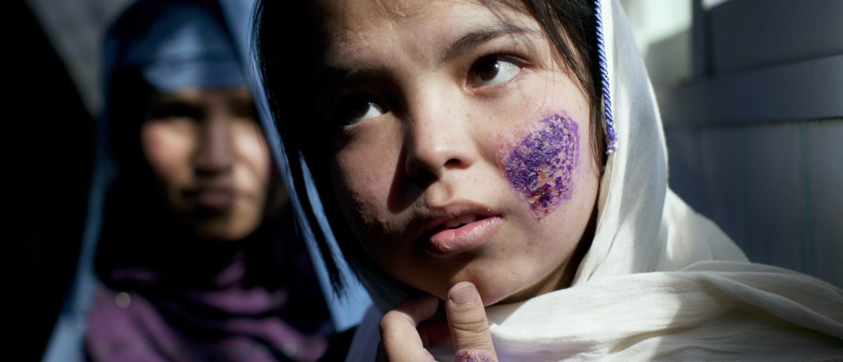 λεϊσμανίαση