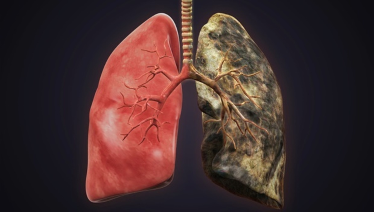 Βίντεο-σοκ: Δείτε τι κάνει το τσιγάρο στους πνεύμονες... - Iatropedia