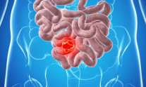 καρκίνος του εντέρου