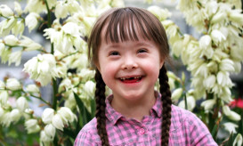 σύνδρομο Down