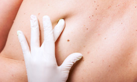 καρκίνος του δέρματος