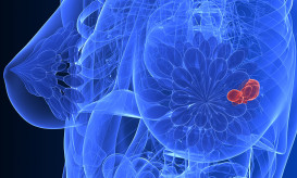 καρκίνος του μαστού