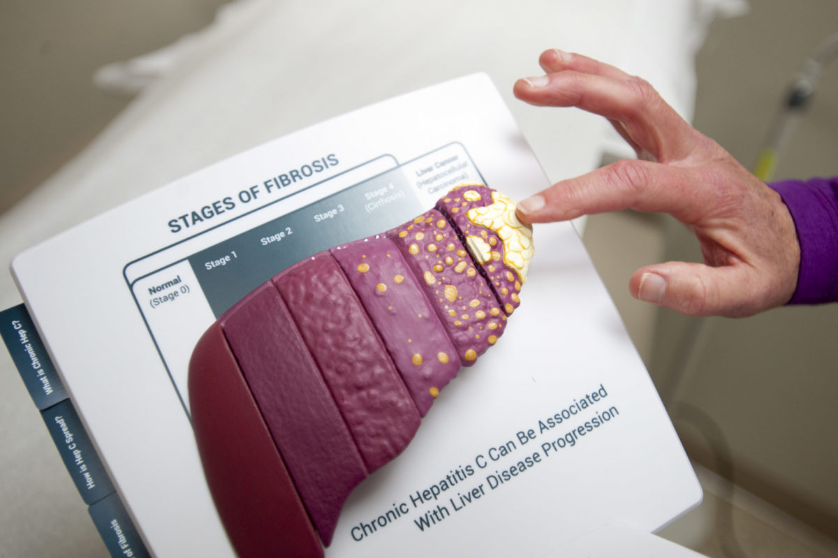 ηπατίτιδα C