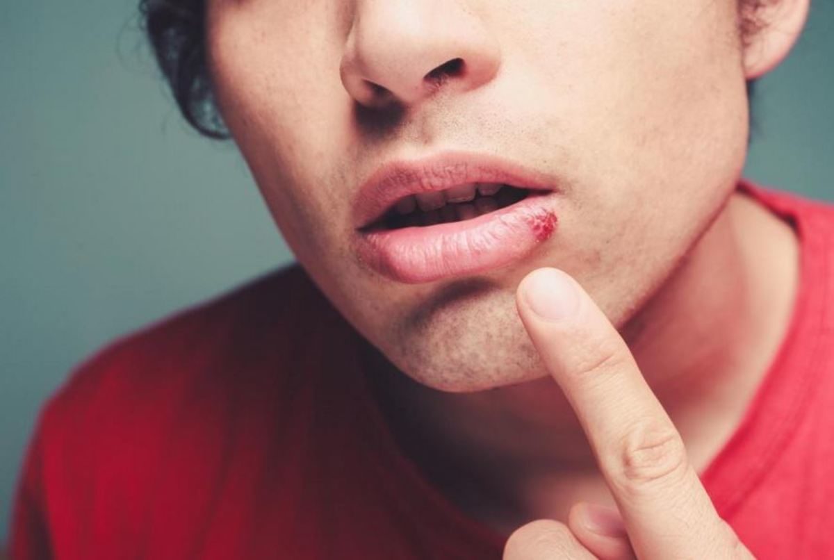 επιχείλιος έρπης