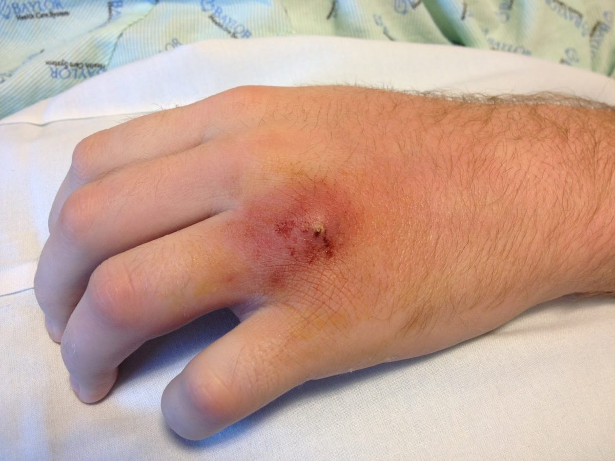 σταφυλόκοκκος