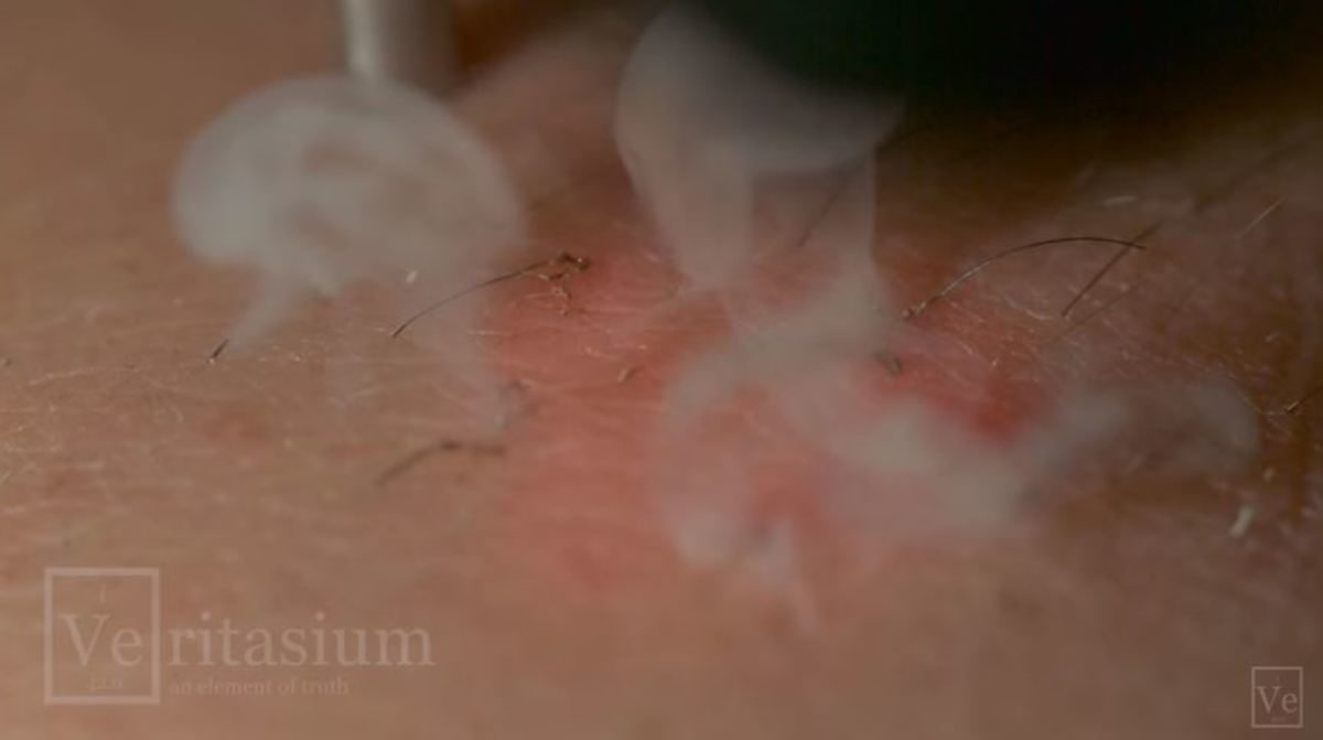 αποτρίχωση