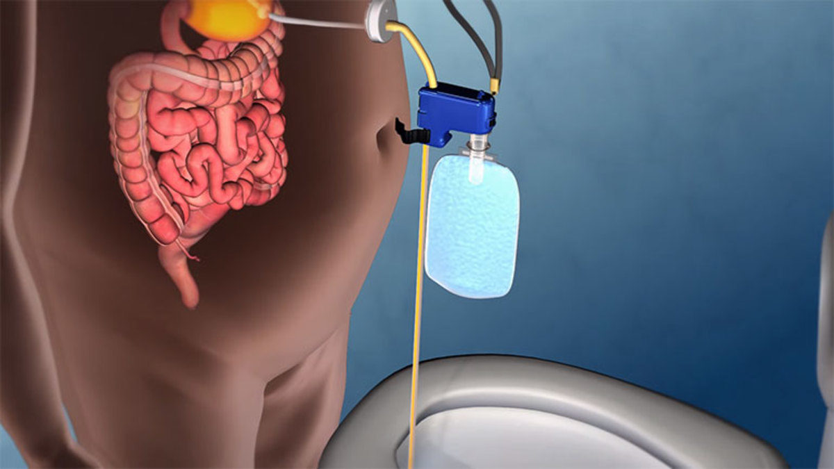 αδυνάτισμα