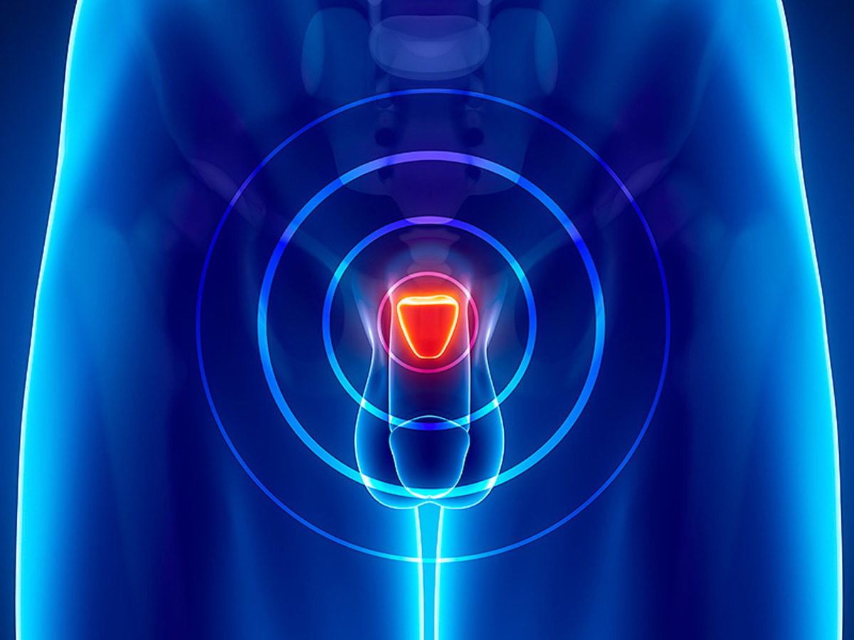 καρκίνος του προστάτη