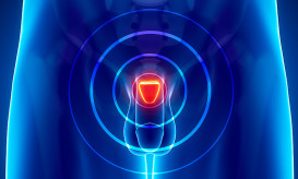 καρκίνος του προστάτη