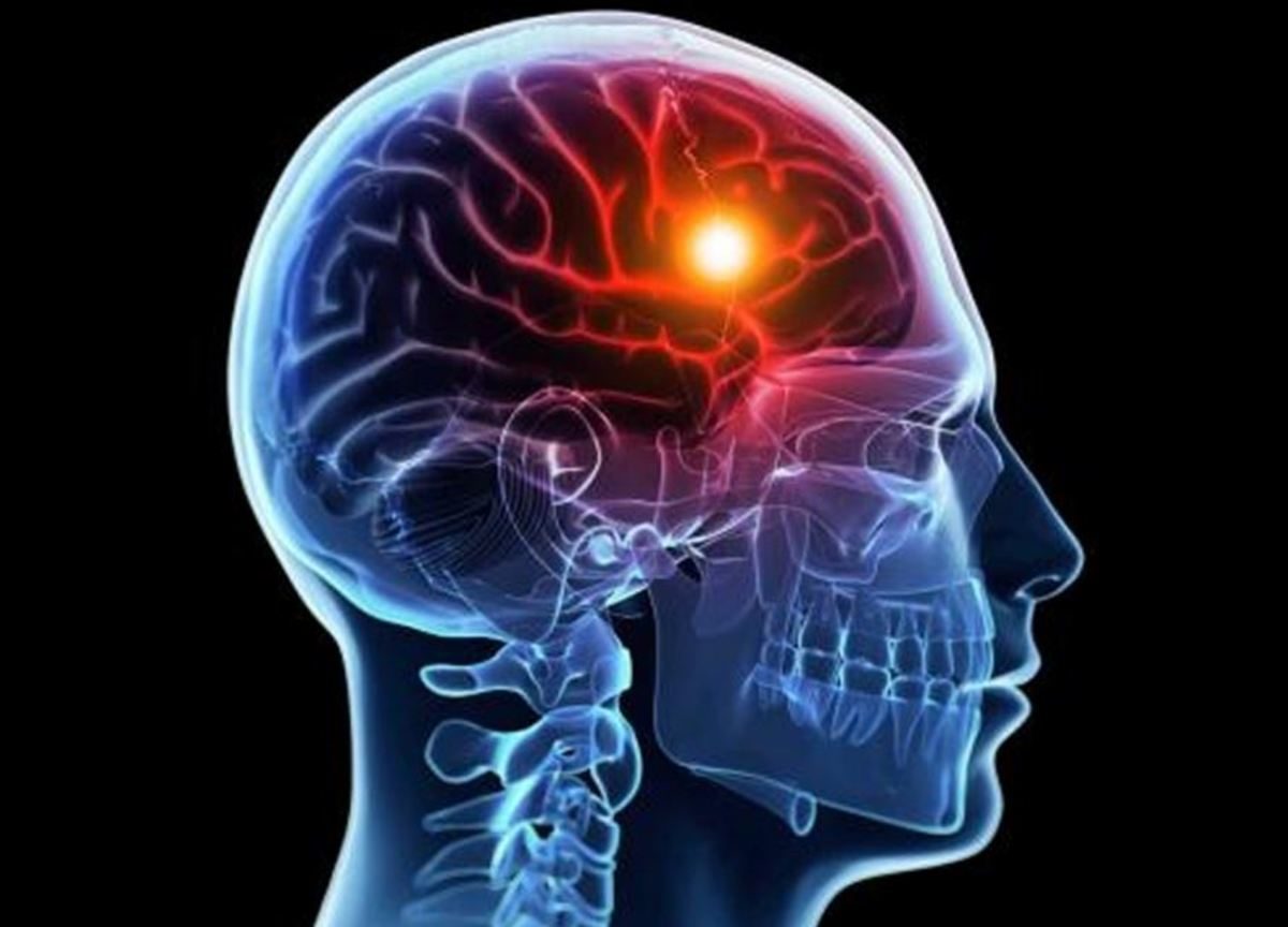 εγκεφαλικό