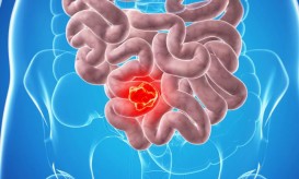 καρκίνος του παχέος εντέρου