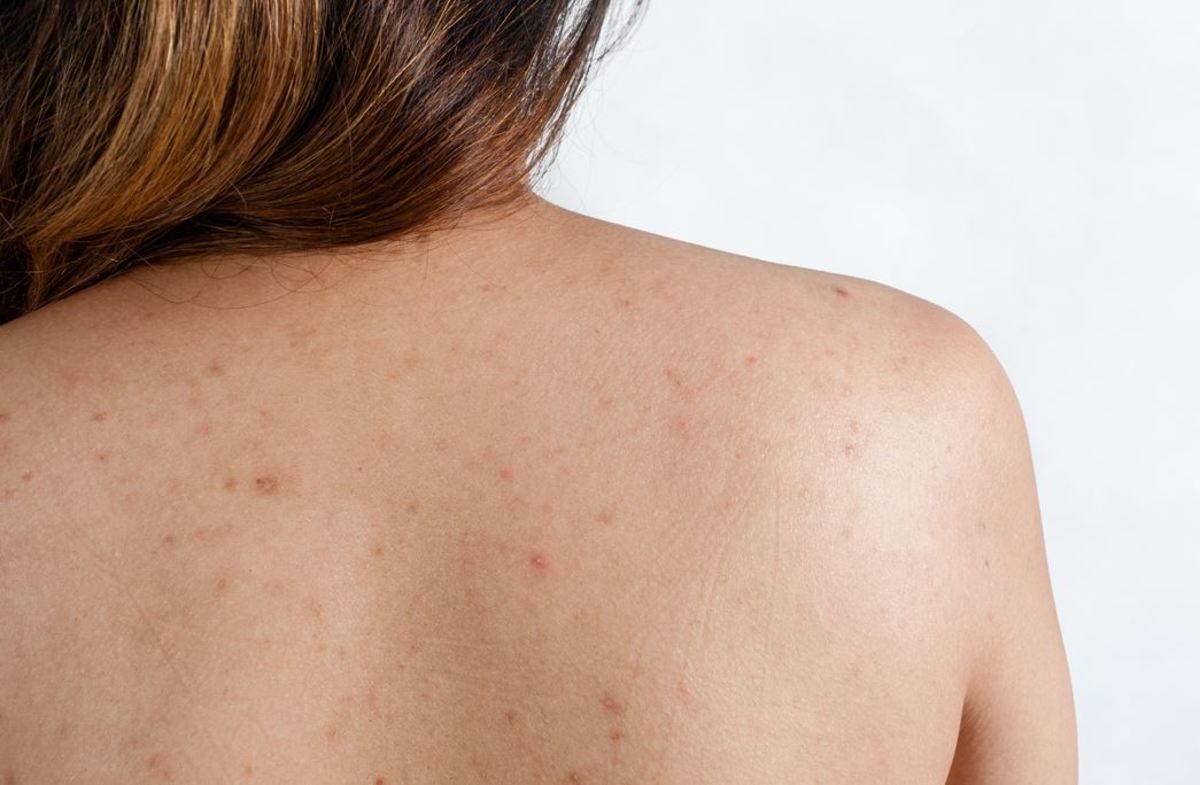 σπυράκια στην πλάτη