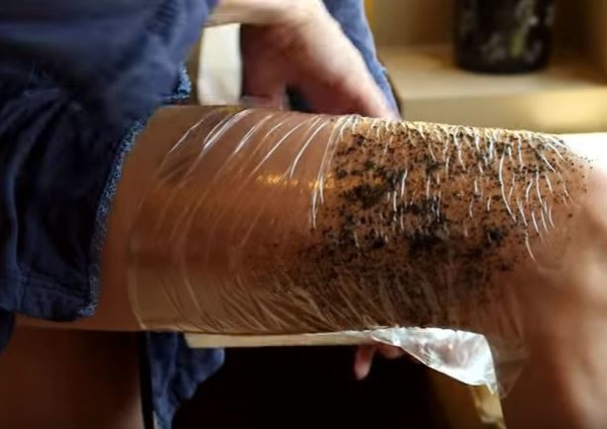 κυτταρίτιδα