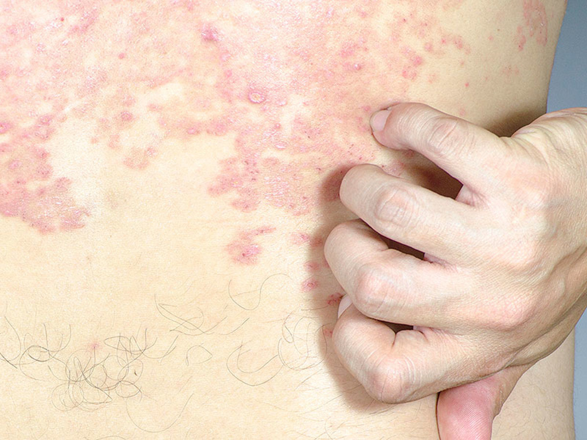 ατοπική δερματίτιδα