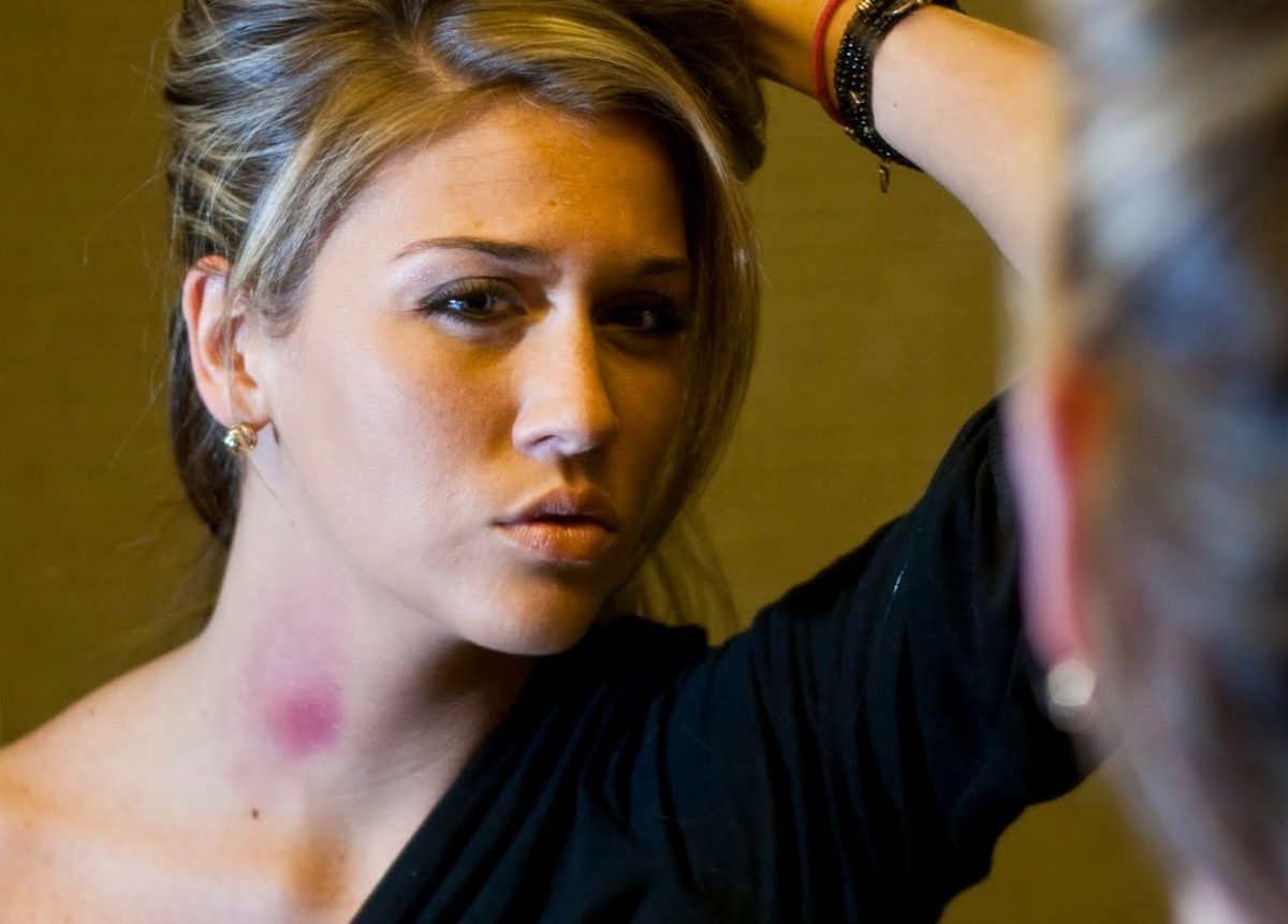 σημάδι στον λαιμό