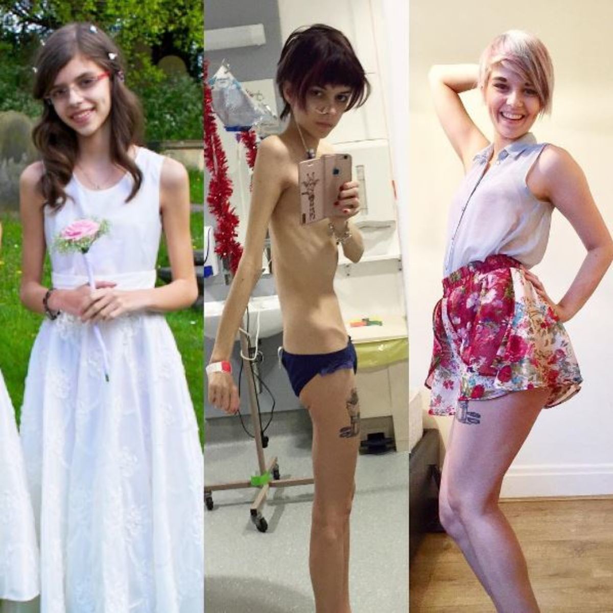 νευρική ανορεξία