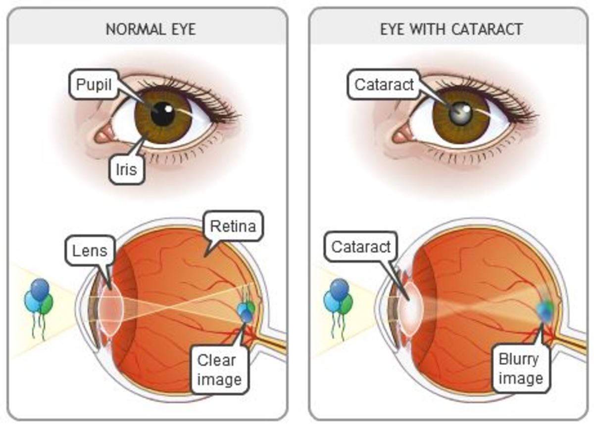 καταρράκτης