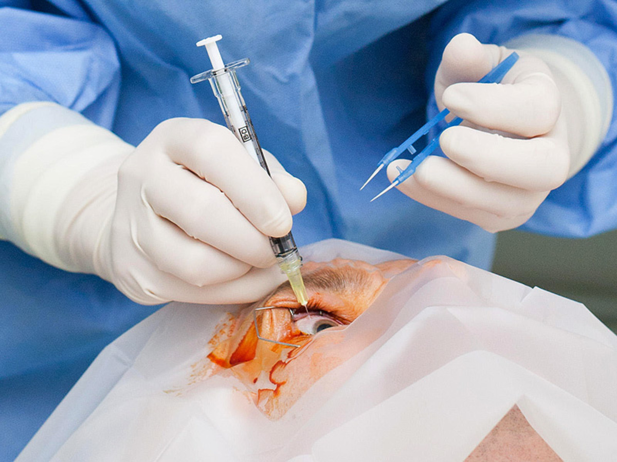 εκφύλιση ωχράς κηλίδας