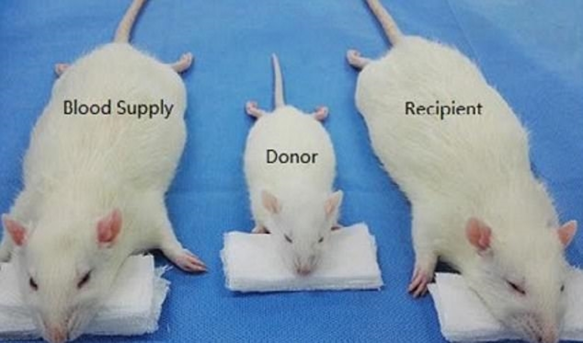 μεταμόσχευση κεφαλιού