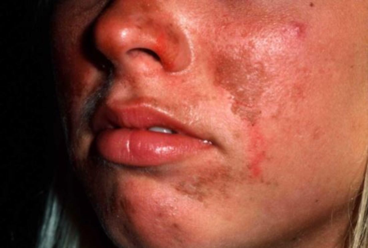 δηλητηρίαση από τον ήλιο