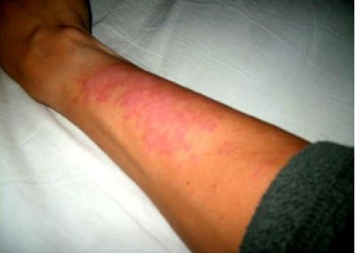 δηλητηρίαση από τον ήλιο