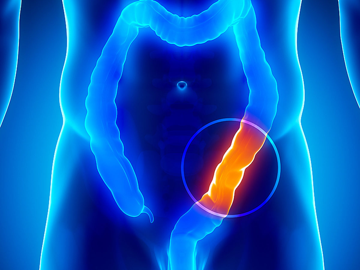 εκκολπωματίτιδα