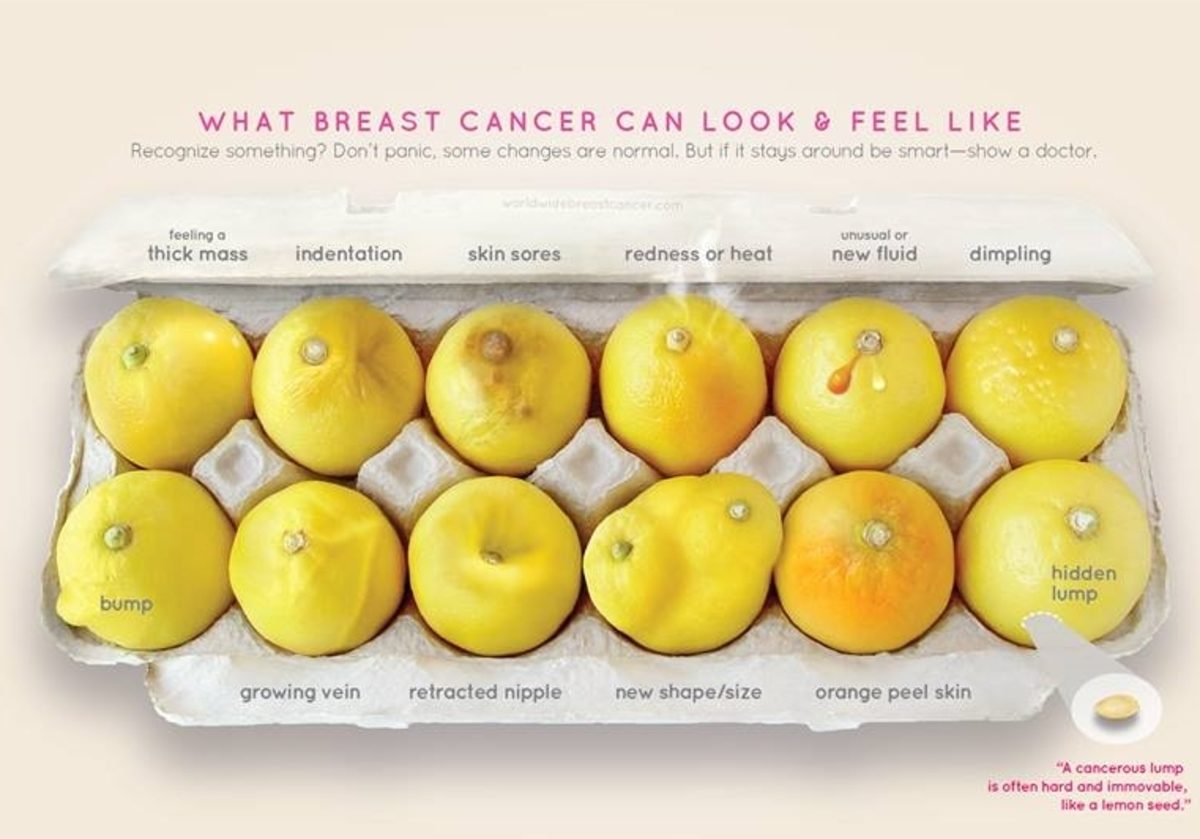 καρκίνος του μαστού