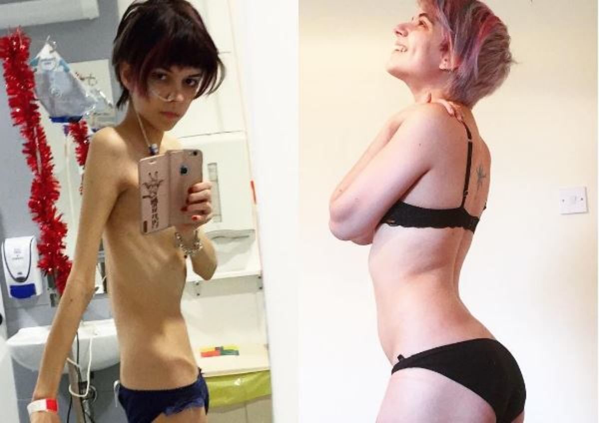 νευρική ανορεξία