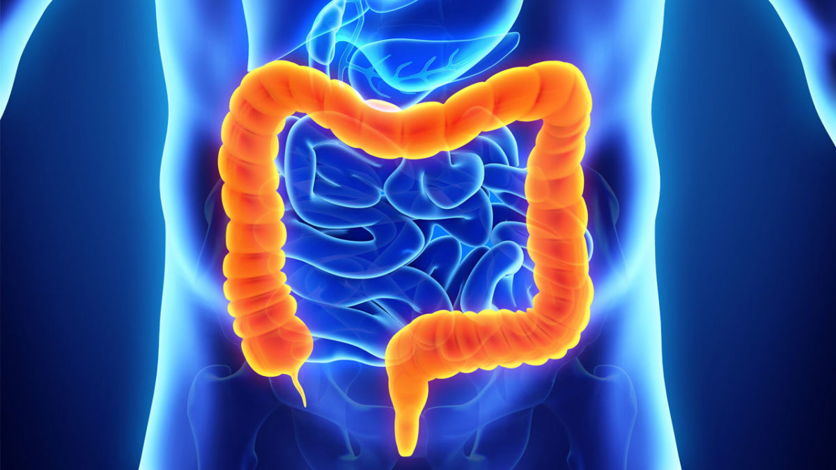 καρκίνος του παχέος εντέρου