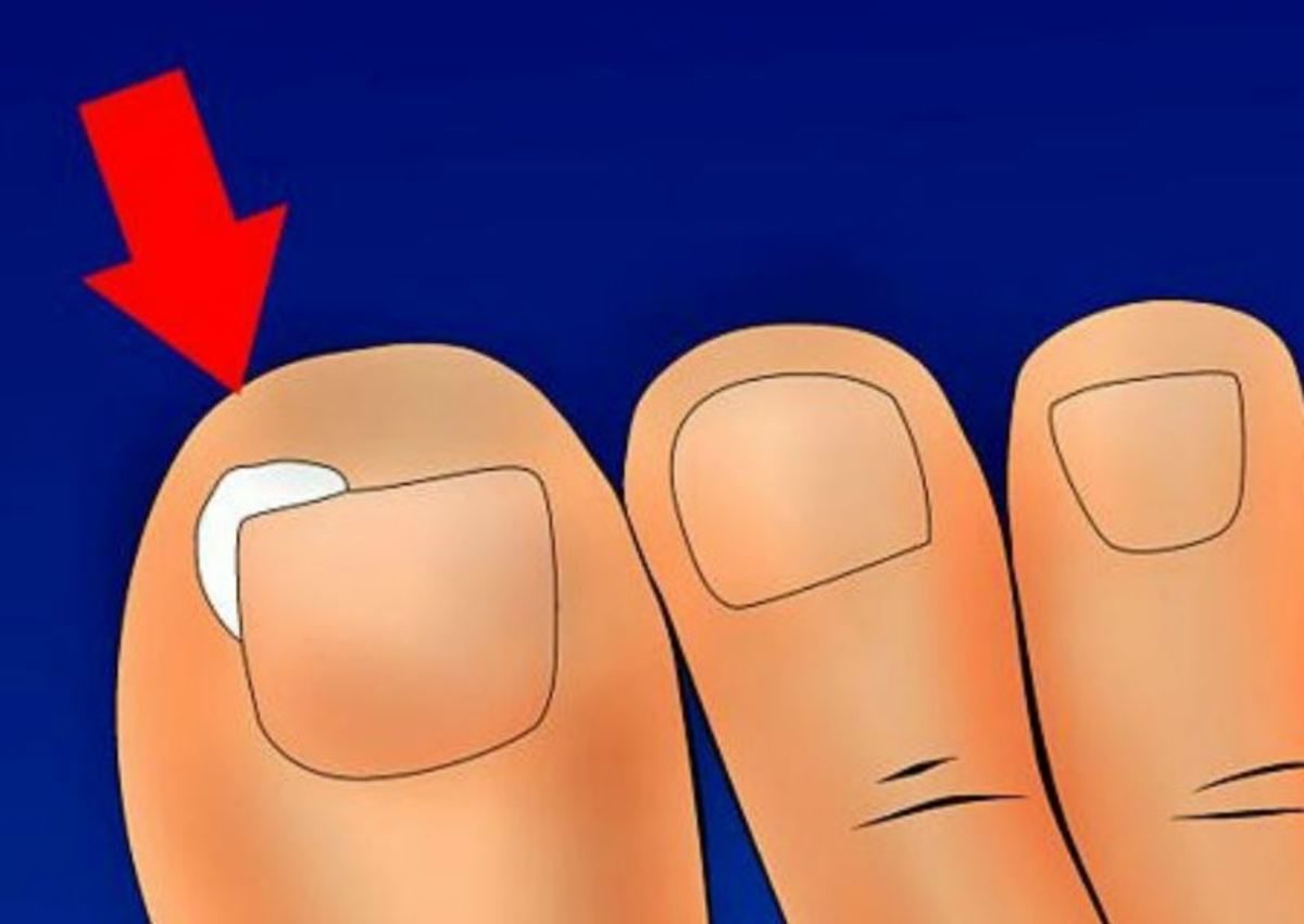 νύχι που μπαίνει στο δέρμα