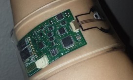 κυστική ίνωση