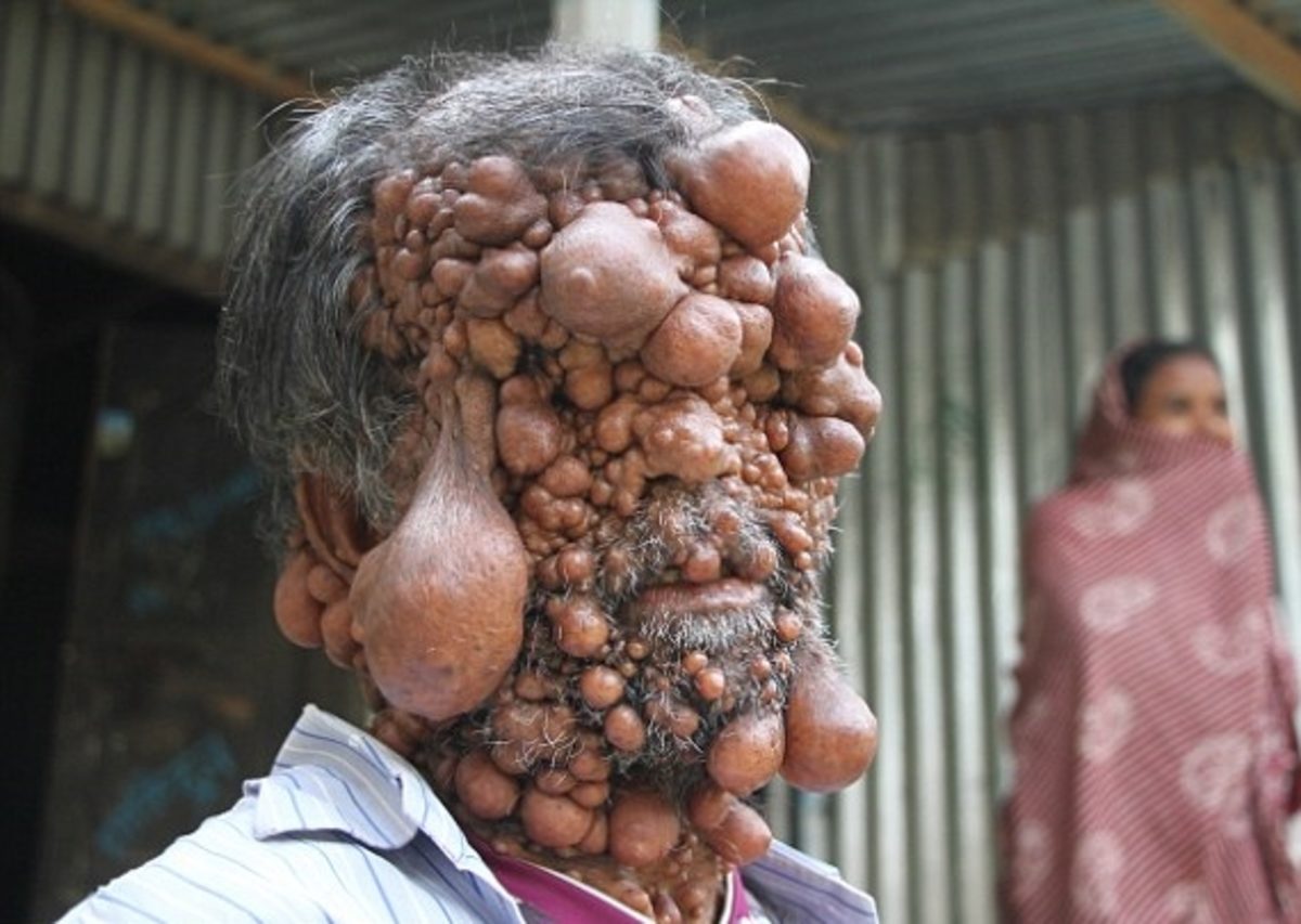 νευροϊνωμάτωση