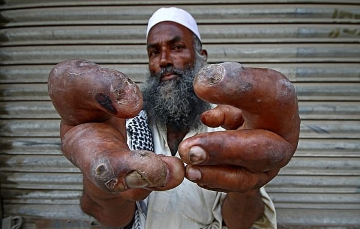 μακροδακτυλισμός