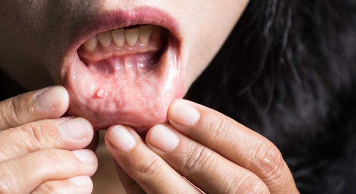 καρκίνος του στόματος