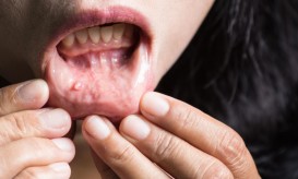 καρκίνος του στόματος