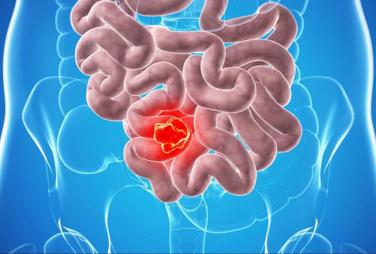 Καρκίνος του παχέος εντέρου