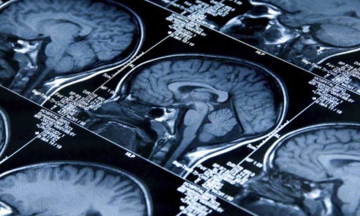 Αλτσχάιμερ