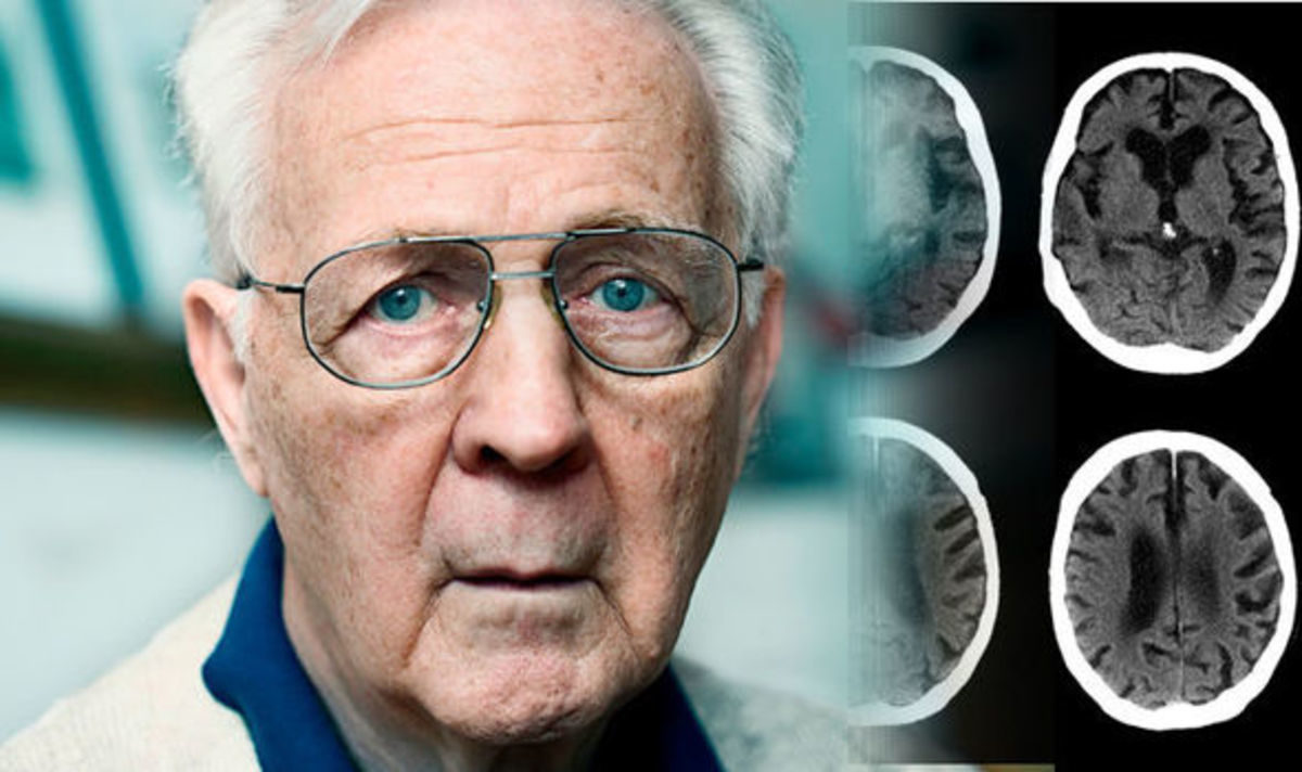 Αλτσχάιμερ