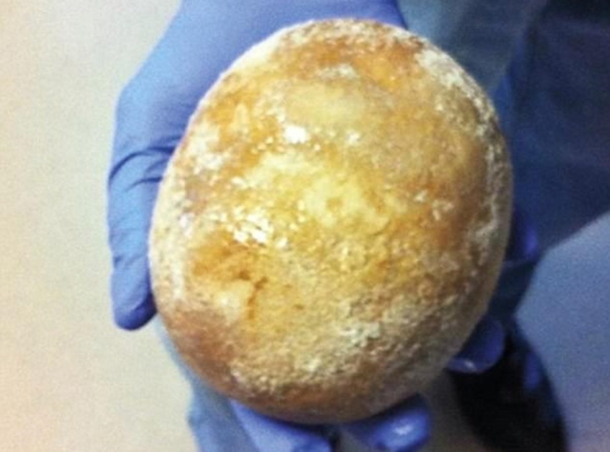 πέτρα στην ουροδόχο κύστη