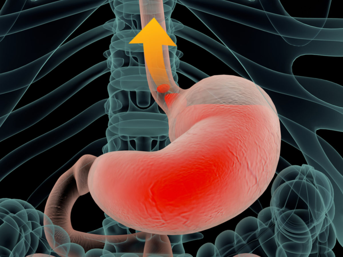 γαστροοισοφαγική παλινδρόμηση