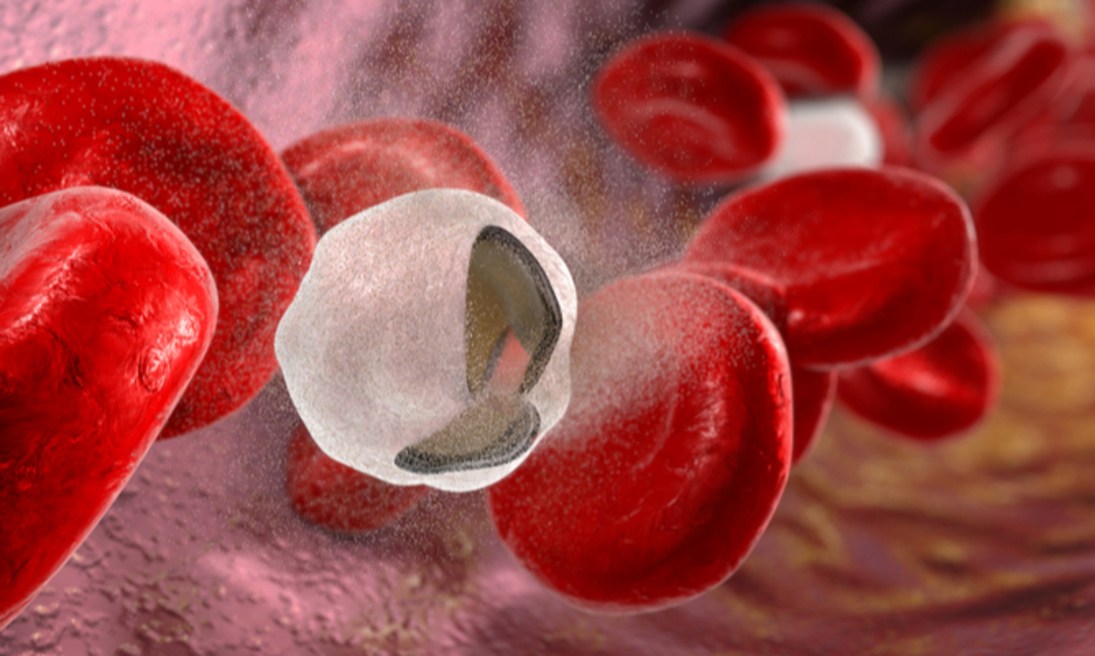 Мазок крови при гемолитической анемии картина крови. Анемия разрушение эритроцитов. Гемолитическая анемия миелограмма. Анемия разрушение эритроцитов. Иммунная гемолитическая анемия в оак.
