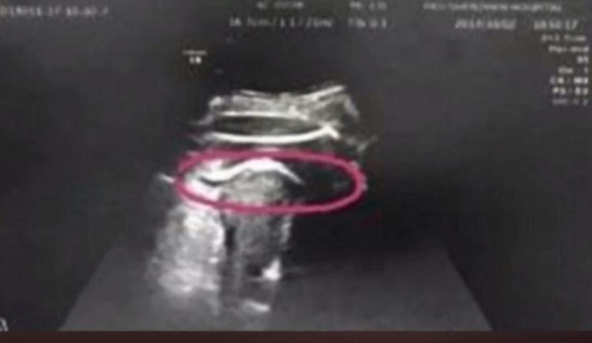 ρήξη μήτρας