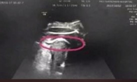 ρήξη μήτρας