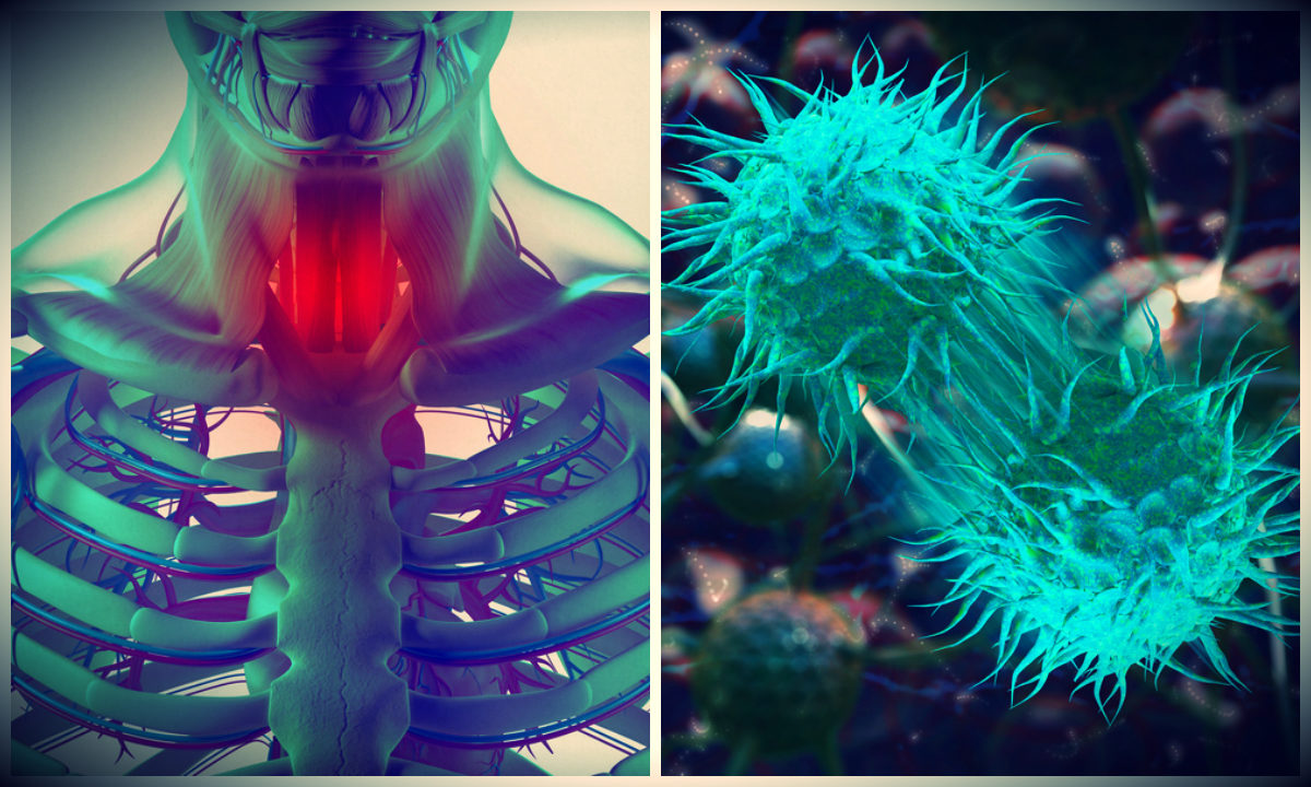 πονόλαιμος